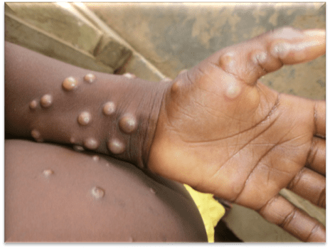 Mpox cases Ghana