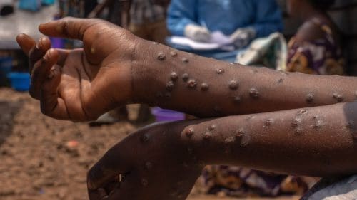 Mpox cases Ghana Health vaccine total